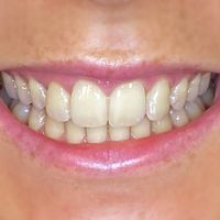 Composite Veneers - Smile 2 before